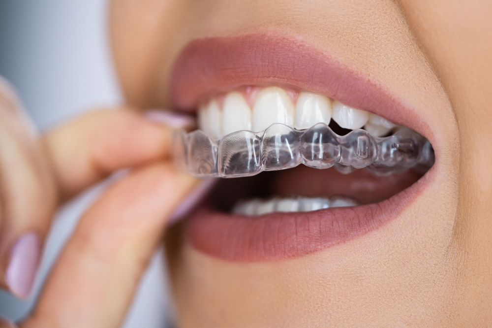 Clear Aligners: Where Comfort Meets Confidence